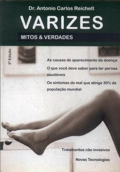 Mitos E Verdades: Varizes