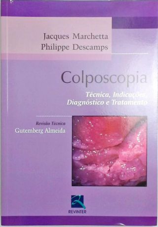 Colposcopia