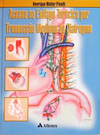 Acesso ao Esôfago Torácico por Transecção Mediana do Diafragma