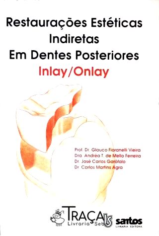 Restaurações Estéticas Indiretas em Dentes Posteriores