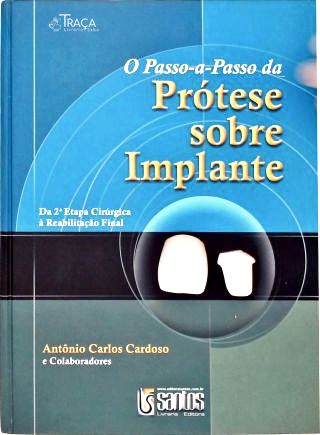 O Passo-a-Passo da Prótese Sobre Implante