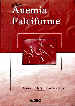 Anemia Falciforme