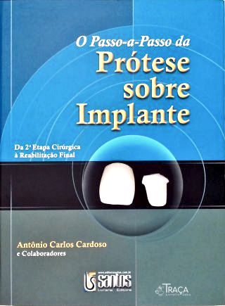O Passo-a-Passo da Prótese Sobre Implante